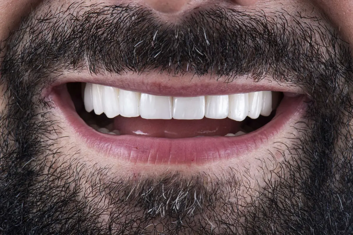 fatete dentare Galati - estetica dentara Galati - clinica Onlysmile