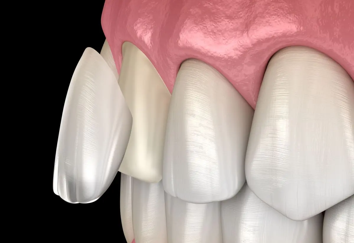 fatete dentare Galati - estetica dentara Galati - clinica Onlysmile