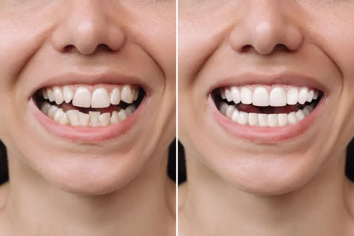 fatete dentare Galati - estetica dentara Galati - clinica Onlysmile