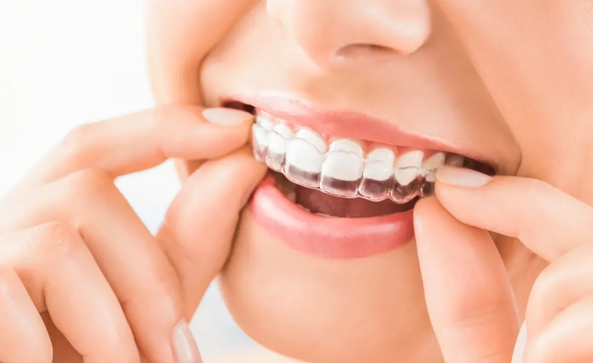 aparat Invisalign Galati: aparat dentar Galati