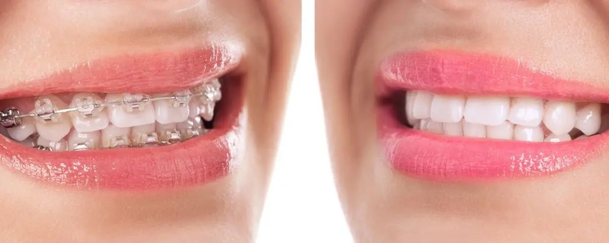 aparat Invisalign Galati: aparat dentar Galati