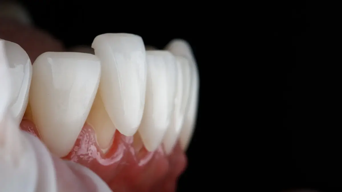 fatete dentare Galati - estetica dentara Galati - clinica Onlysmile