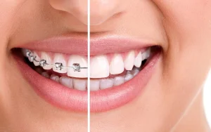 aparat Invisalign Galati: aparat dentar Galati